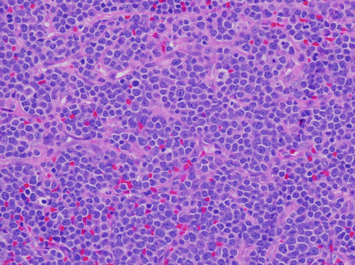 H&E stained sections of the right neck lymph node demonstrated near complete effacement of the lymph node architecture by a paracortical infiltrate of monomorphic immature lymphoid cells with finely dispersed chromatin, scant cytoplasm, irregular nuclear contours, and finely dispersed chromatin with indistinct to small nucleoli. No eosinophilic infiltrates or immature myeloid populations were identified.